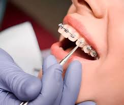 Clareamento Dental - miniatura 2